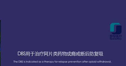 颅内双功能区联合刺激